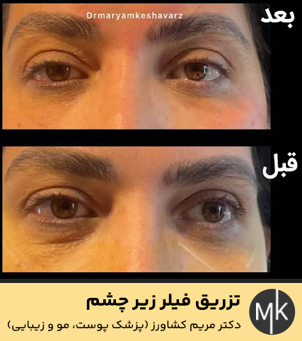 تزریق-فیلر-زیر-چشم