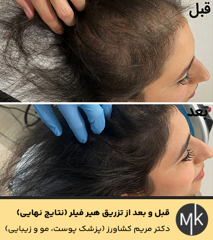 قبل-و-بعد-از-تزریق-هیر-فیلر-(نتایج-نهایی)