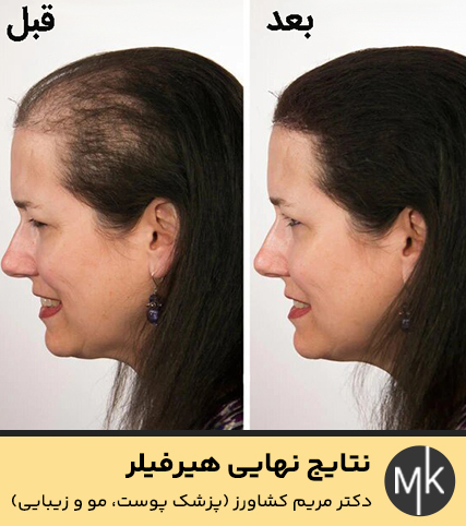 نتایج-نهایی-هیرفیلر