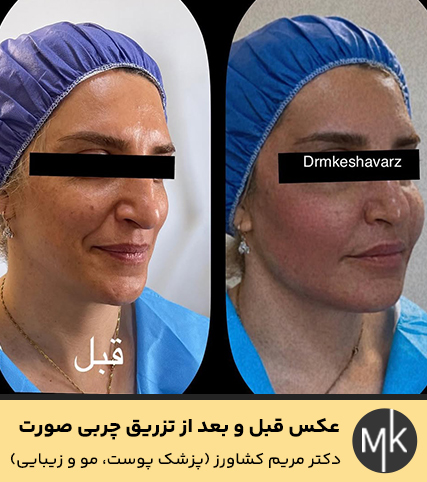 عکس-قبل-و-بعد-از-تزریق-چربی-صورت