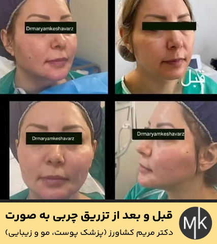 قبل-و-بعد-از-تزریق-چربی-به-صورت