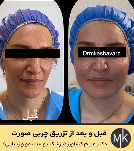 قبل-و-بعد-از-تزریق-چربی-صورت