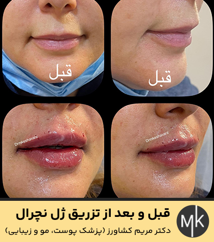 قبل-و-بعد-از-تزریق-ژل-نچرال