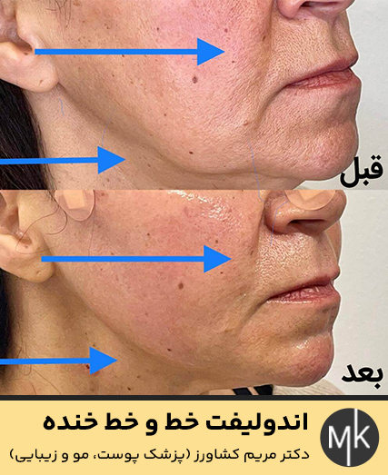 اندولیفت-خط-و-خط-خنده