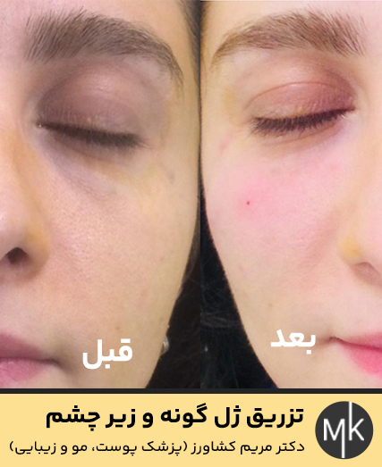 تزریق-ژل-گونه-و-زیر-چشم