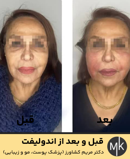 قبل-و-بعد-از-اندولیفت