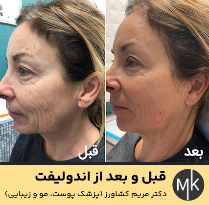 قبل-و-بعد-از-اندولیفت
