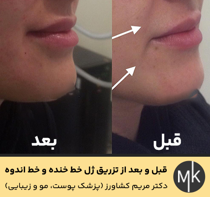 قبل-و-بعد-از-تزریق-ژل-خط-خنده-و-خط-اندوه