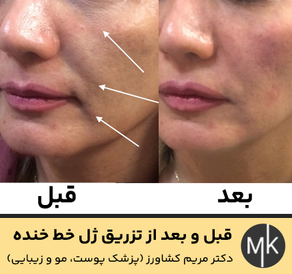 قبل-و-بعد-از-تزریق-ژل-خط-خنده