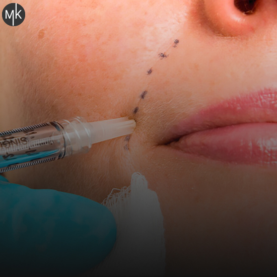 تزریق-ژل-خط-خنده-در-اصفهان