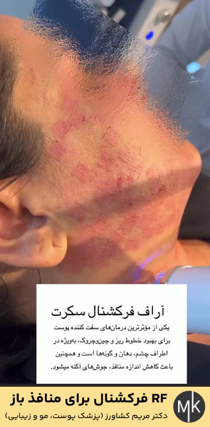 RF-فرکشنال-برای-منافذ-باز