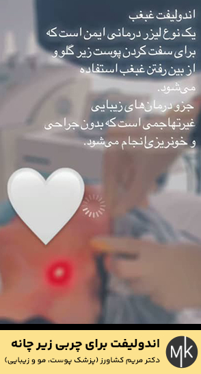 اندولیفت-برای-چربی-زیر-چانه