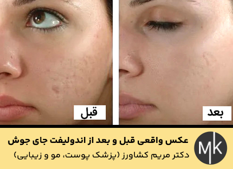 عکس-واقعی-قبل-و-بعد-از-اندولیفت-جای-جوش