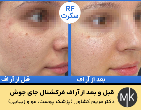 قبل-و-بعد-از-آر اف-فرکشنال-جای-جوش