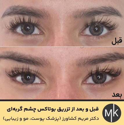 قبل-و-بعد-از-تزریق-بوتاکس-چشم-گربه‌ای