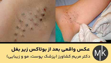 عکس-واقعی-بعد-از-بوتاکس-زیر-بغل