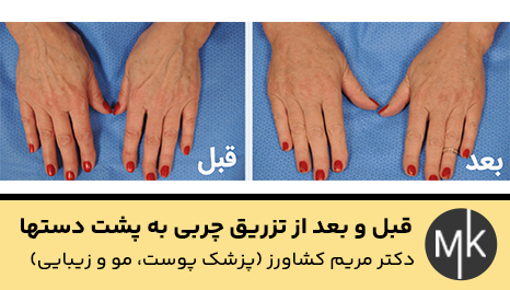 قبل-و-بعد-از-تزریق-چربی-به-پشت-دستها