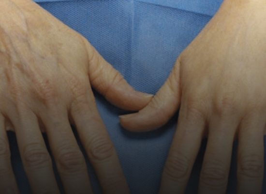 تزریق-چربی-به-دستها-در-اصفهان