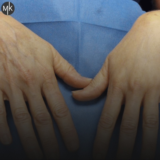 تزریق-چربی-به-دستها-در-اصفهان