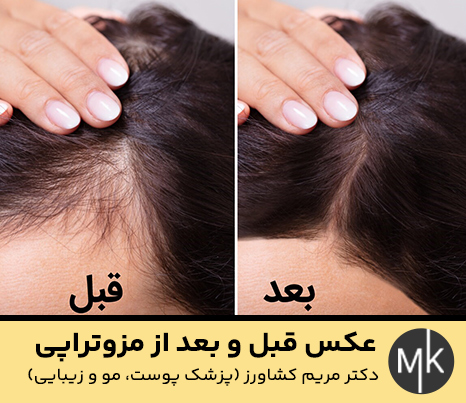 عکس-قبل-و-بعد-از-مزوتراپی