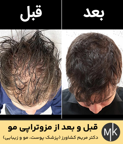 قبل-و-بعد-از-مزوتراپی-مو