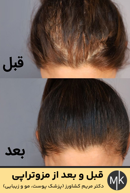 قبل-و-بعد-از-مزوتراپی