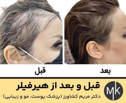 قبل-و-بعد-از-هیرفیلر