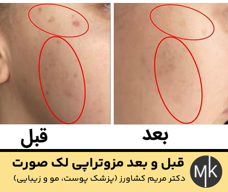 قبل-و-بعد-مزوتراپی-لک-صورت