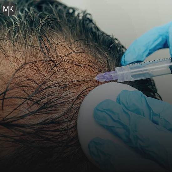 مزوتراپی-برای-ریزش-مو