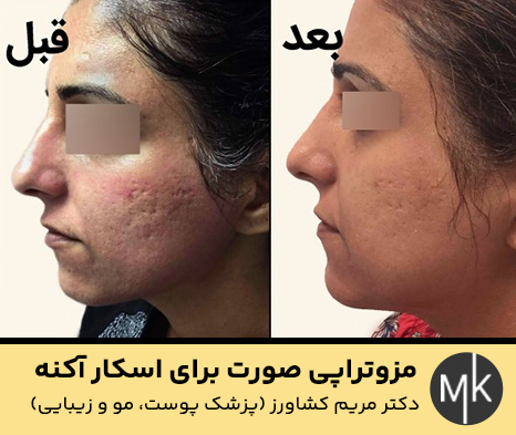 مزوتراپی-صورت-برای-اسکار-آکنه