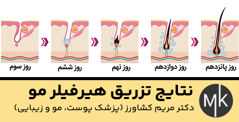 نتایج-تزریق-هیرفیلر-مو