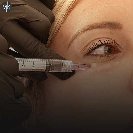 کاندیدای-مزوتراپی-صورت