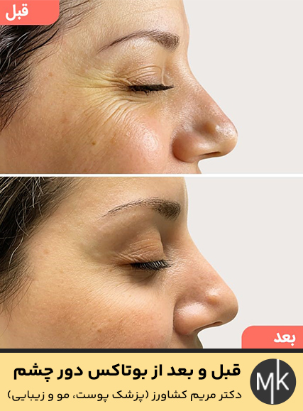 قبل-و-بعد-از-بوتاکس-دور-چشم