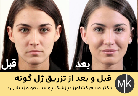 قبل-و-بعد-از-تزریق-ژل-گونه