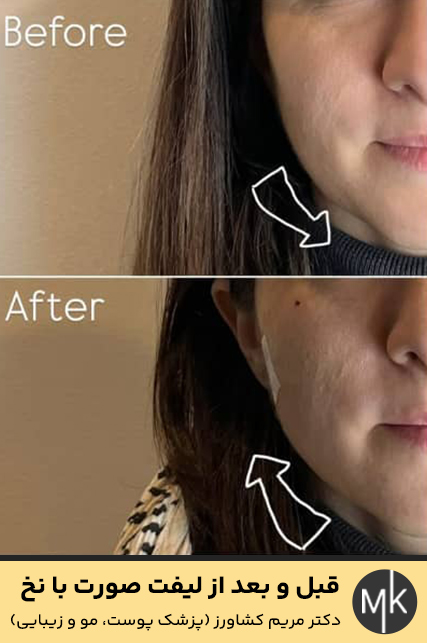 قبل-و-بعد-از-لیفت-صورت-با-نخ