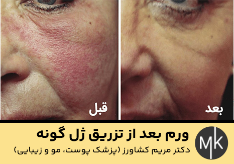 ورم-بعد-از-تزریق-ژل-گونه