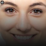 درمان-خطوط-پنجه-کلاغی-دور-چشم--در-اصفهان-با-تزریق-بوتاکس