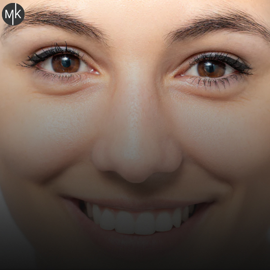 درمان-خطوط-پنجه-کلاغی-دور-چشم--در-اصفهان-با-تزریق-بوتاکس