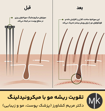 تقویت-ریشه-مو-با-میکرونیدلینگ