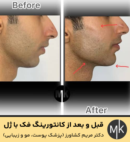 قبل-و-بعد-از-کانتورینگ-فک-با-ژل