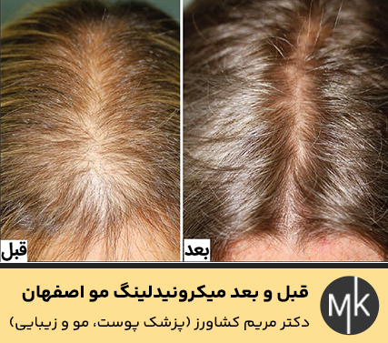 قبل-و-بعد-میکرونیدلینگ-مو-اصفهان