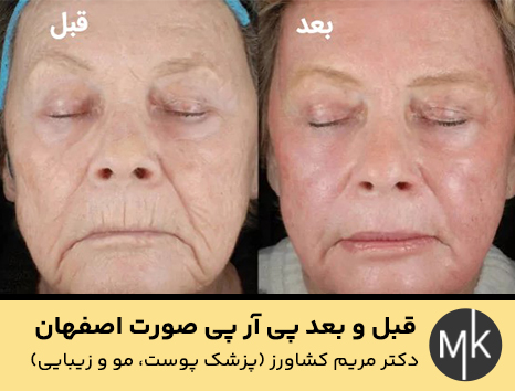 قبل-و-بعد-پی-آر-پی-صورت-اصفهان