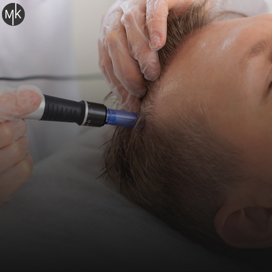 میکرونیدلینگ-مو-در-اصفهان-با-نتایج-تضمینی-و-ماندگار