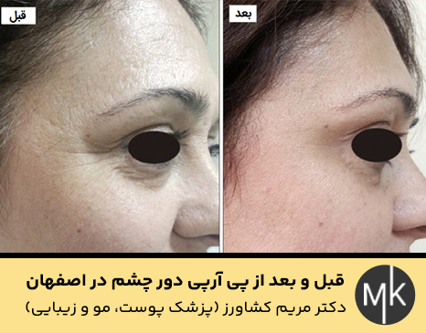 قبل-و-بعد-از-پی-آرپی-دور-چشم-در-اصفهان
